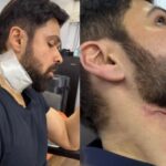 Emraan Hashmi Injured on The Set of Adivi Sesh’s ‘Goodachari 2’